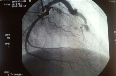 冠脉造影：集诊断、治疗于一体的冠心病“先进准”检查