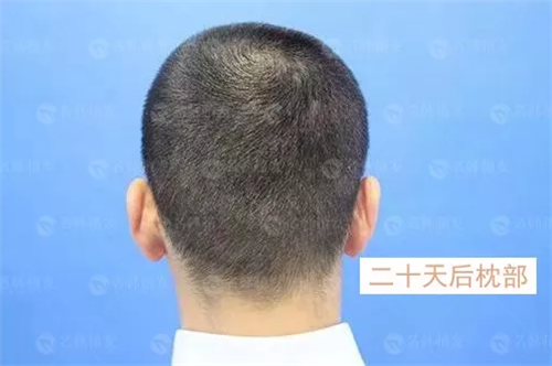 发际线种植陈先生：做完植发，终于可以自信的面对身边的人了