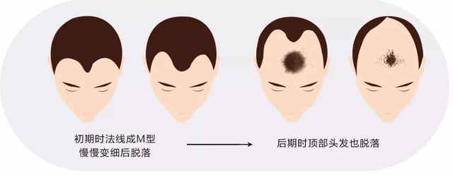 男性秃顶植发效果好不好，应该如何进行护理呢？专家来告诉你