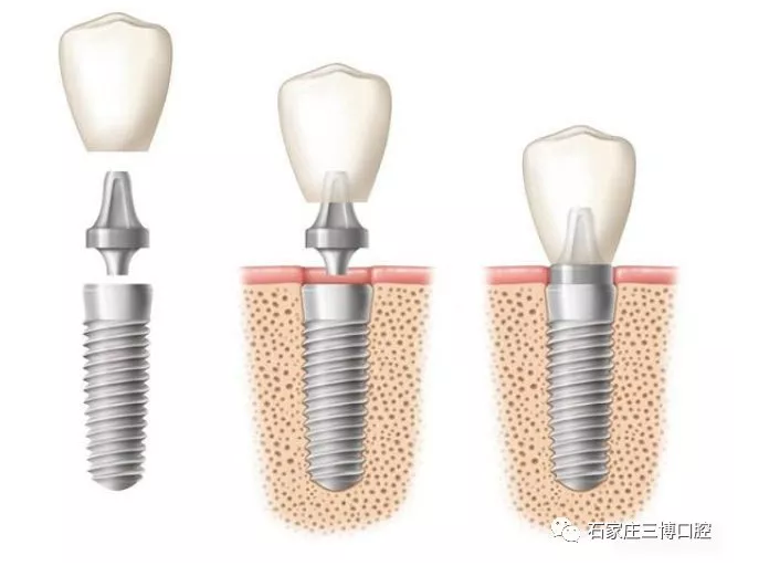 种植牙和镶牙到底该如何选择？种植牙和镶牙分别是什么？