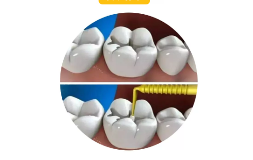 全瓷嵌体和传统补牙有什么区别？这几点一定要注意