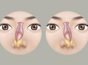 北京看耳鼻喉科-怎样预防鼻中隔偏曲