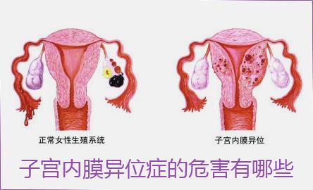 子宫内膜异位症引起的原因和危害，你都知道吗？