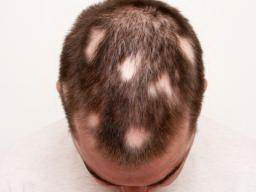 斑秃有哪些早期症状出现