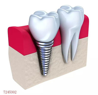 种植牙术后该如何护理?这些绝招你都知道吗？