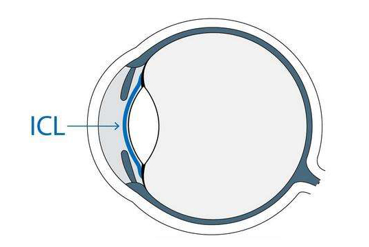 哪些人适合通过ICL晶体植入术矫治近视