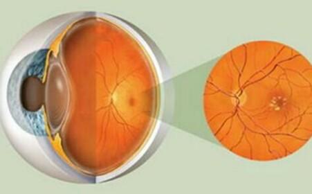 眼底病常见两症状,预防从定期查眼底开始_北京熙仁眼科医院