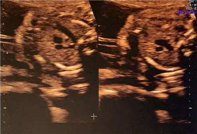 孕期要做的超声影像(四维彩超)检查，这些你都知道吗?