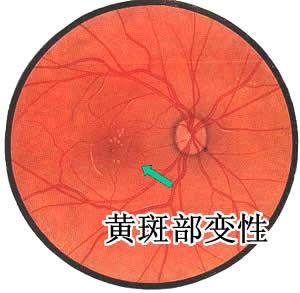 北京熙仁眼科医院：如何及时发现黄斑病变，教你这三种方法!