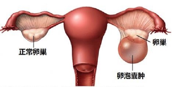 卵巢囊肿能怀孕吗？卵巢囊肿的危害有哪些？