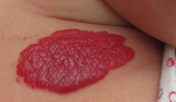 草莓状血管瘤
