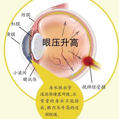北京熙仁眼科医院：青光眼早期症状不明显，教你如何诊断！