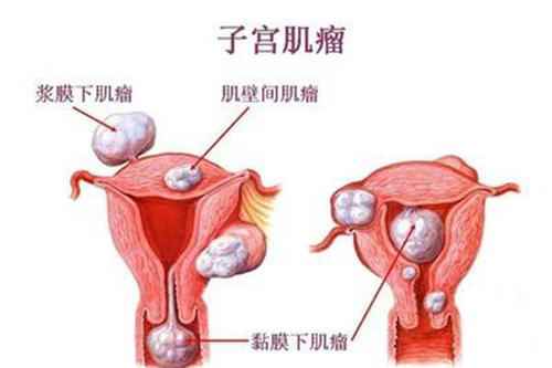 子宫肌瘤患者术后慎用红枣,这些术后事项快收藏!