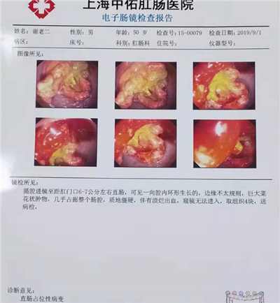 上海中佑肛肠医院：45岁以上人群应每年做肠镜筛查