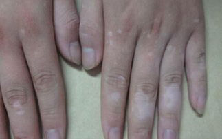 白癜风手指初期症状有哪些？大概分为几种？