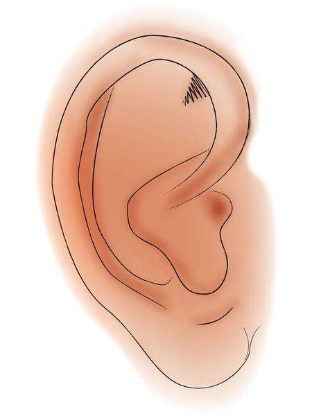 耳朵有堵塞感怎么治疗？看完文章就明白