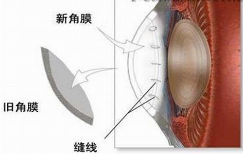 角膜移植的手术类型有几种，适应症如何？再不看就晚了