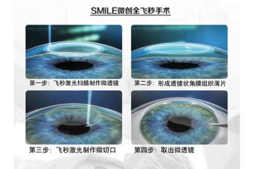 近视手术医生详解—近视眼激光手术