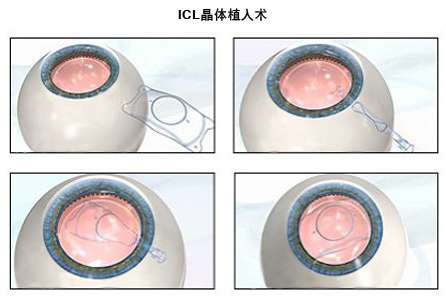 ICL和TICL晶体植入术有哪些优势