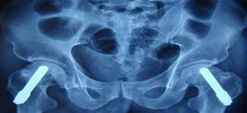 股骨头坏死是什么原因？专家解析股骨头坏死的病因