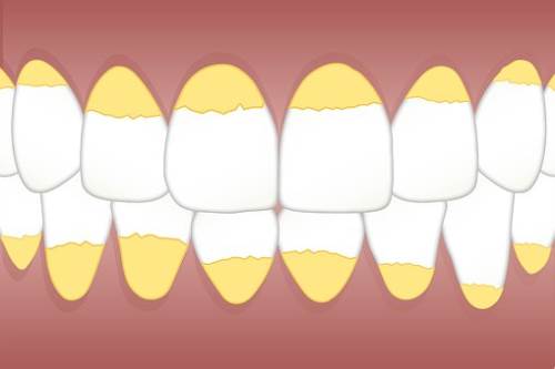 牙结石有哪些危害?通过哪些食物可以去除?