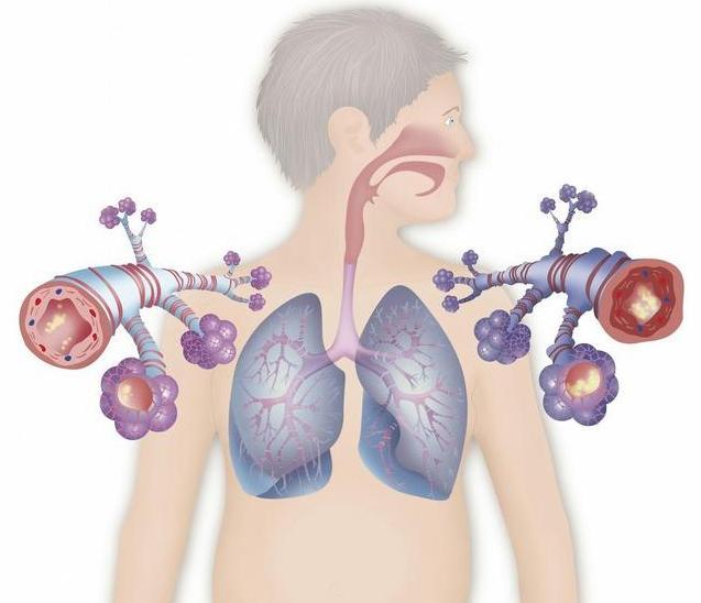 气管炎和支气管炎如何分辨？