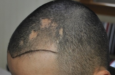 头上有块疤怎样才能重新长出头发?
