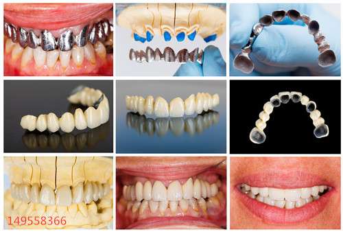 烤瓷牙重做既花钱又遭罪，如何鉴别烤瓷牙优劣