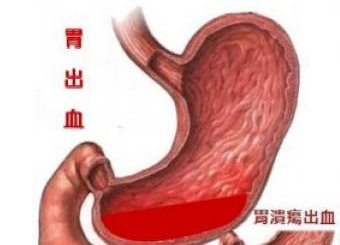 胃镜检查浅表性胃炎，有胃胀打嗝，怎么办？