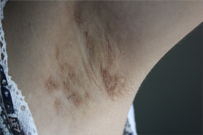 手术疤痕的危害有哪些？这几点你知道吗？