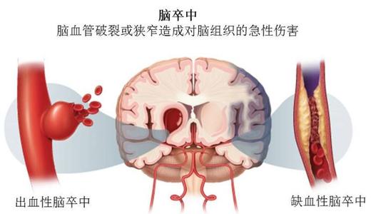 一次卒中相当于身体的一次8级地震！