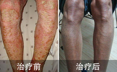 银屑病之殇无人诉说  潍坊治愈展笑颜
