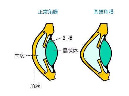 全飞秒医生提醒你，圆锥角膜是什么样的