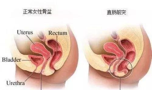 产后肛肠病--北京丰益肛肠医院：产后不得不说的三件“肛部事”