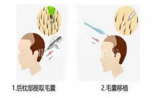头发种植术步骤介绍