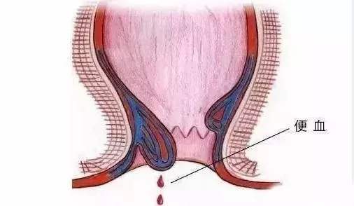 深圳远大肛肠医院|大便时出血？直肠癌借痔疮“蒙混过关” 