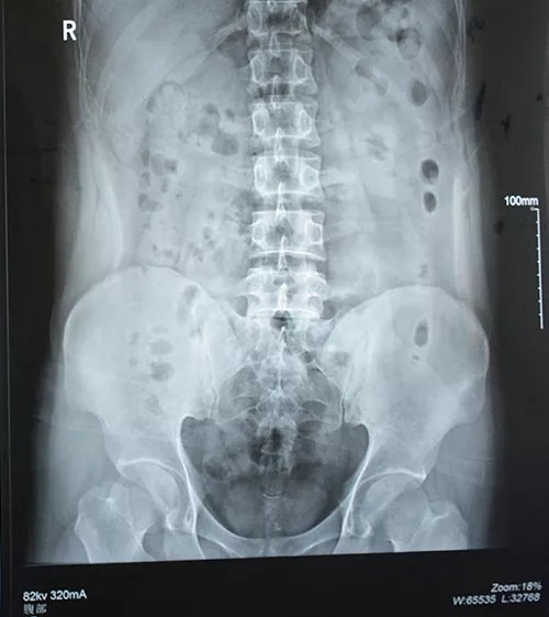 左侧输尿管中段结石、左肾结石、左侧输尿管狭窄患者，外院治疗手术失败，特来龙蟠取石！