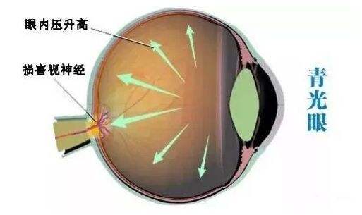 青光眼患者还需要做哪些保养护理工作