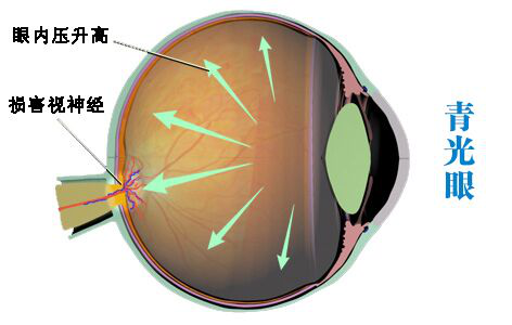 青光眼有什么症状表现？这些知识一定要了解