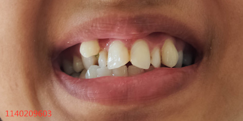 正畸能让牙齿畸形重新恢复牙齿形状，但也是有弊端的。