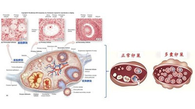 多囊卵巢综合征调理方法有哪些？术后该如何护理呢？