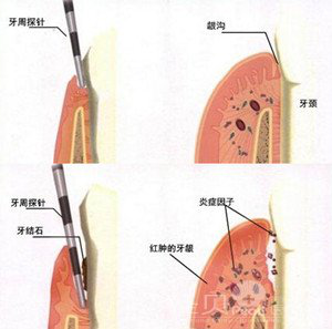 牙龈出血是什么原因？怎么治疗？了解清楚才放心