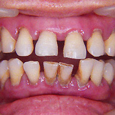 牙龈萎缩是怎么引起的？应该怎么治疗？了解一下吧