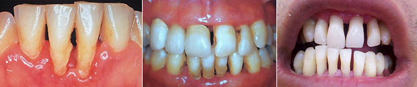 牙龈萎缩是怎么引起的？应该怎么治疗？了解一下吧