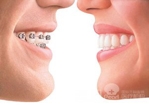 医生详解：牙齿矫正的相关注意事项，早看早知道