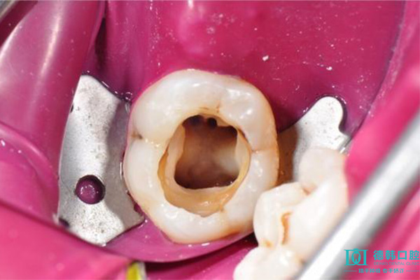 持久间缺牙能否做种植牙？与活动假牙对比如何？
