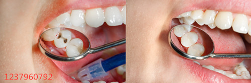 补牙的时候，牙医都在我嘴里做了什么？