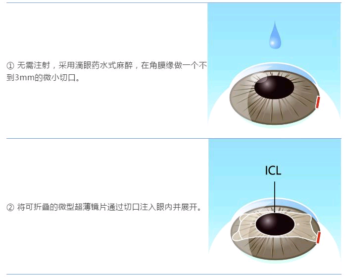 ICL人工晶体植入术，让高度近视患者摘镜不再是梦想！