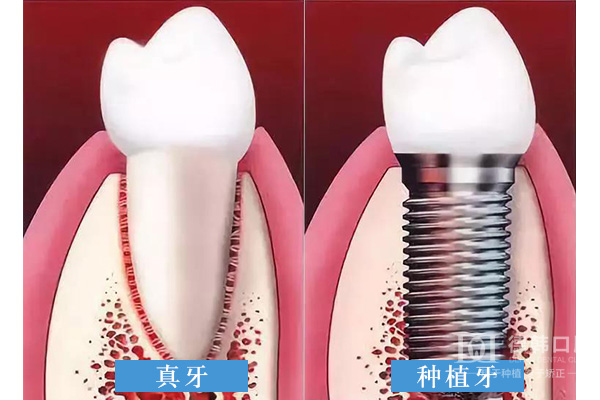 什么样的牙齿适合牙齿美白？了解一下吧