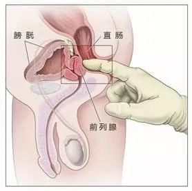 北京丰益肛肠医院：肛部指检2分钟内查出80%的直肠癌！